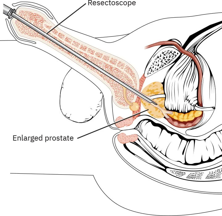 A complex color illustration showing the insertion of a resectoscope into the urethra to reach the prostate.
