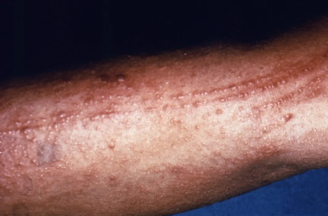 A closeup photo of an arm with contact dermatitis shows a large enflamed rash.