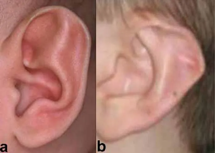 A photo of two ears; the left photo shows a normal ear, while the right photo shows an ear with an extra horizontal fold of cartilage.