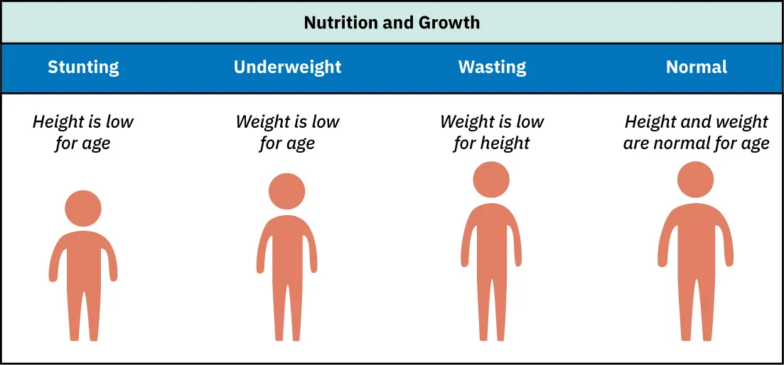 Chart listing Types of Undernutrition- Stunting: Height is low for age; Underweight: Weight is low for age; Wasting: Weight is low for height; Normal: Height and weight are normal for age.