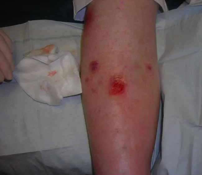 Photograph of venous stasis ulcer in leg.