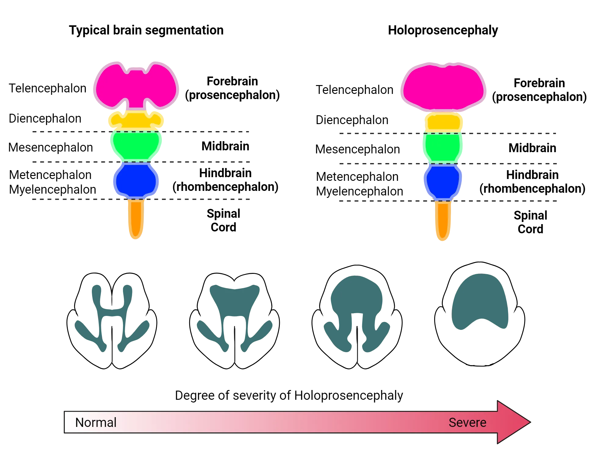 Top shows diagrams contrasting early segmented neural tube that is typical versus that in holoprosencephaly. The holoprosencephaly tube has less fully formed bilateral protrusions from midline, particularly in the forebrain. Bottom shows several diagrams of a horizonal section of human brain each with varying degrees of holoprosencephaly. Normal has two defined cortical lobes, one on each side. The lobes become less separated and more unified with increasing severity. The most severe shows one cortical lobe centered at midline with no bilateral separation.