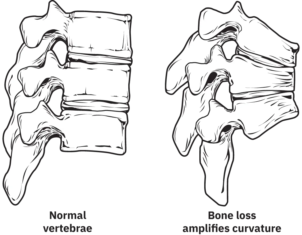 Diagrams showing normal vertebrae and how bone loss amplifies curvature