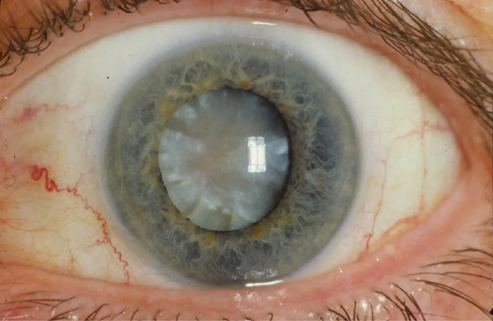 Cataract