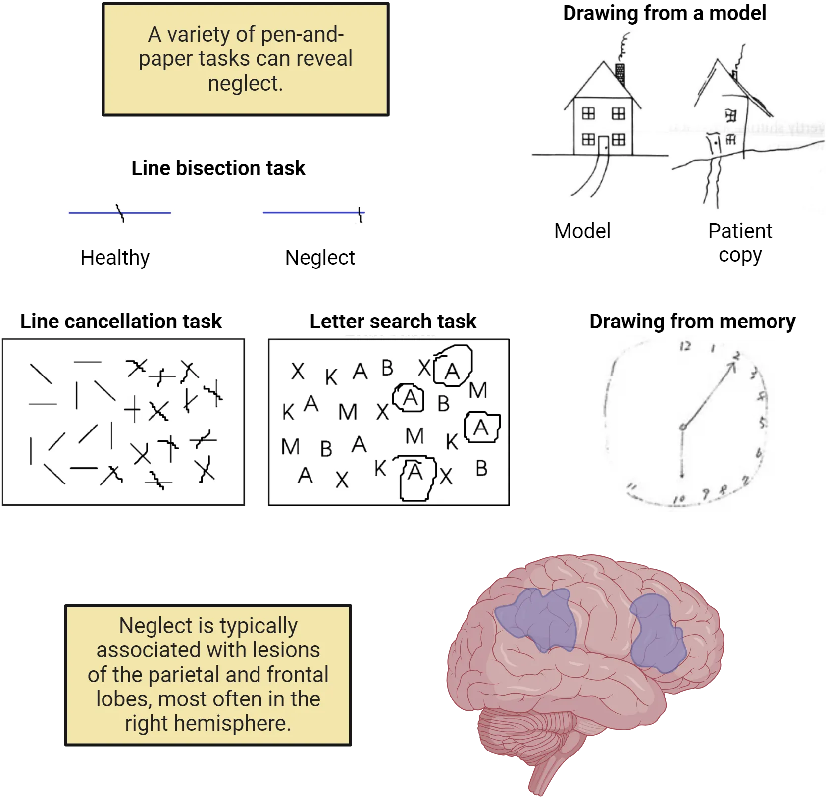Top: Examples of tasks described in the main text as completed by healthy participants and neglect patients. Decorative. Bottom: Diagram of human brain showing highlights in right frontal and parietal cortices