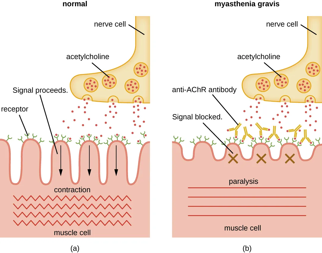 a) Myasthenia gravis and impaired muscle contraction. Description below.