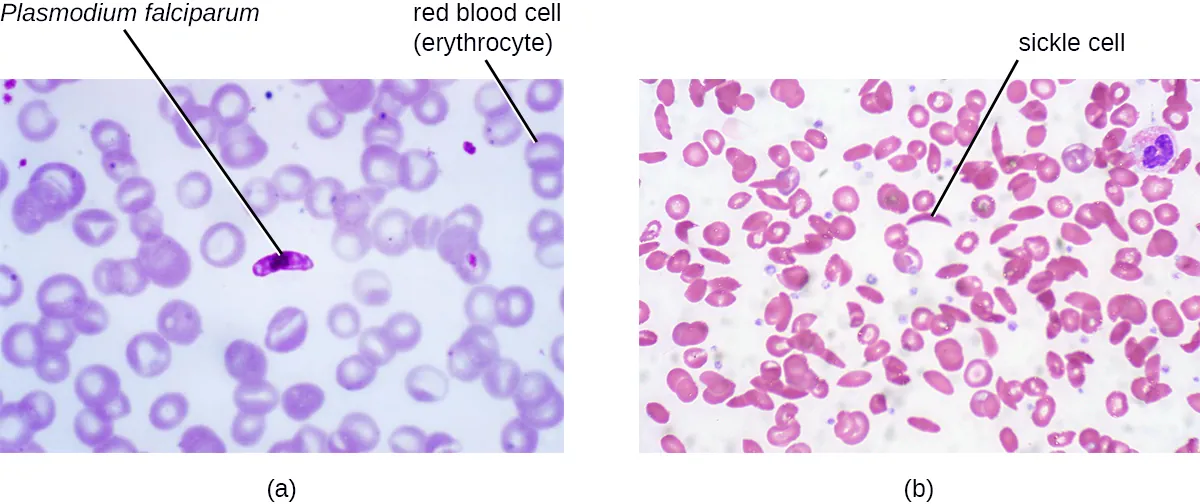 Sickle cell anemia. Description below.