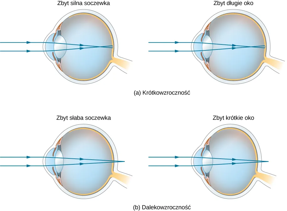 Figura a przedstawia dwa schematy oka ludzkiego oznaczone “soczewka zbyt silna” i “oko zbyt długie”. Na obu rysunkach równoległe promienie padające na rogówkę skupiają się przed siatkówką. Figura b pokazuje dwa schematy oka opisane “soczewka zbyt słaba” i “oko zbyt krótkie”. W obu przypadkach równoległe promienie padające na rogówkę skupiają się za siatkówką.