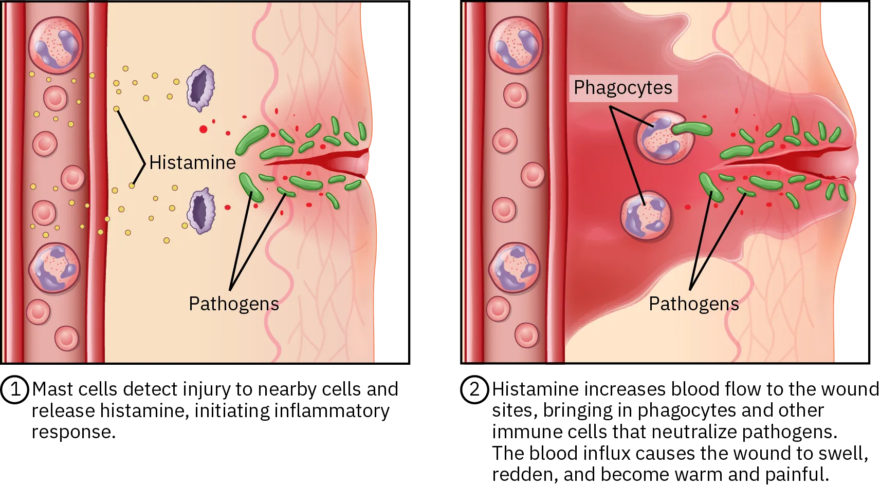 Two diagrams show the inflammatory response when skin is cut. Mast cells detect the pathogens that have been introduced into the body through the cut. They release histamines, which causes mild inflammation and redness. The histamines increase blood flow to the wound, bringing in phagocytes and other immune cells to neutralize the pathogens. The additional blood causes the wound to swell, redden, and become painful.