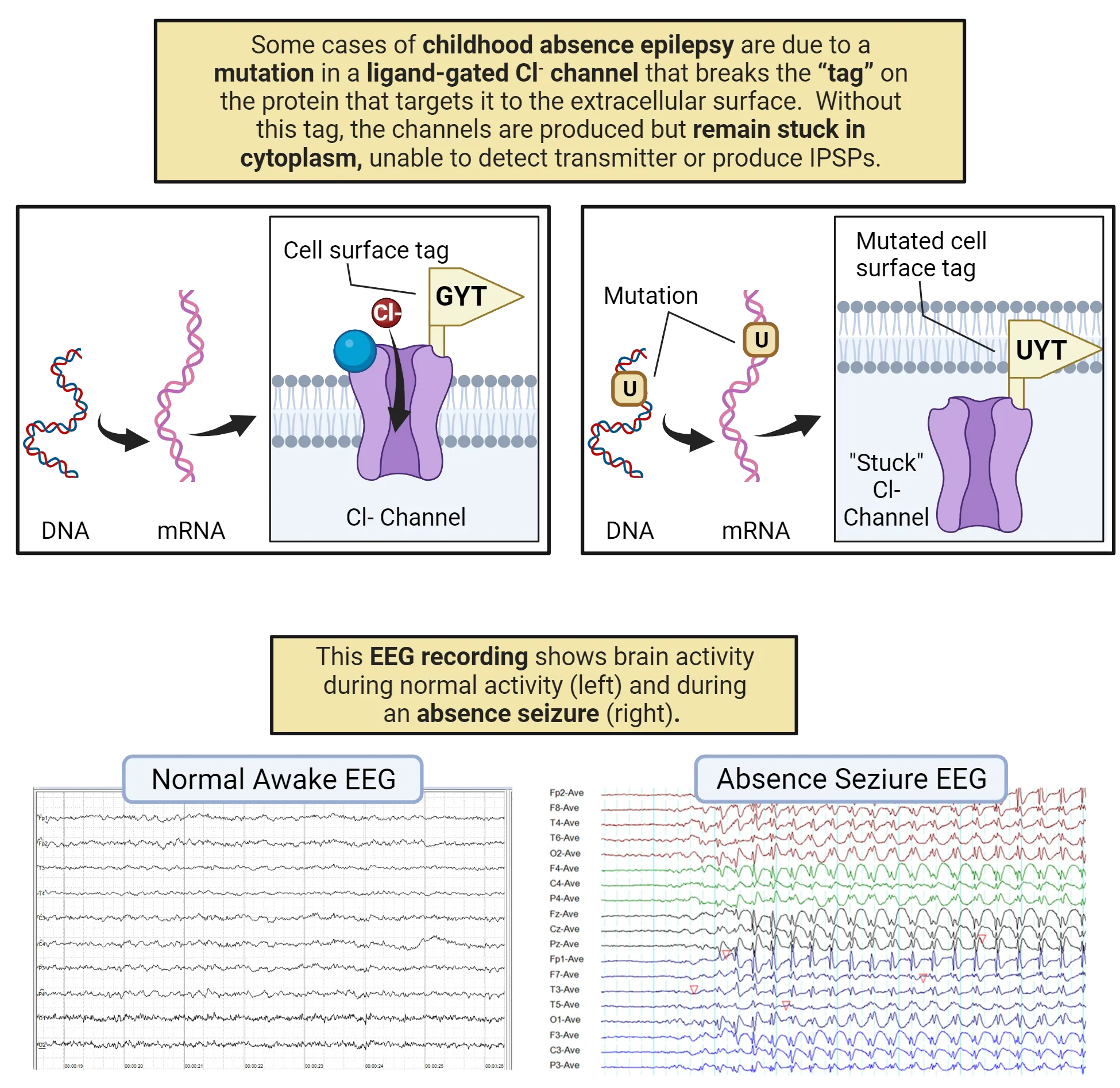 Top: Left: Diagram of normal Cl- channel in cell membrane, allowing Cl- in the cell. Right: Diagram of cell with mutated Cl- channel stuck inside the cell. Bottom: Screenshot of EEG recordings in normal awake person and during an absence seizure.