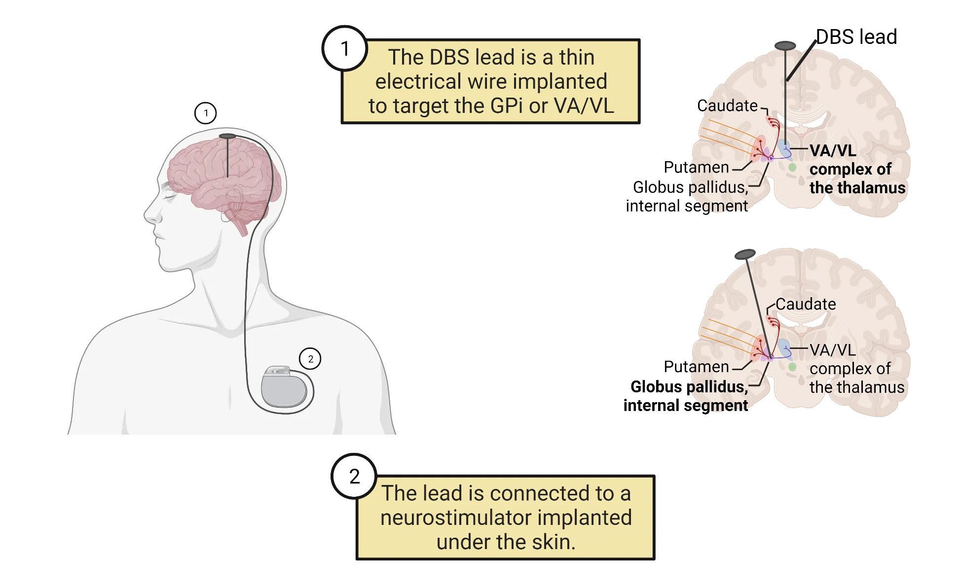 Left: Diagram of a human head/torso, with a brain surface view plus a deep brain stimulation device implanted. Right: Coronal brain sections showing DBS leads targeting the VA/VL of thalamus or the globus pallidus, internal segment.
