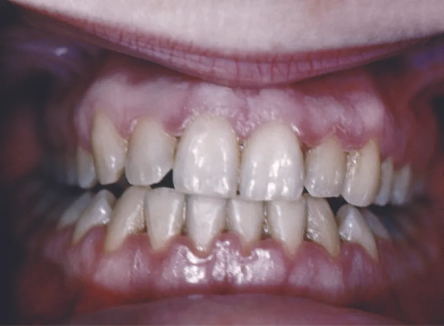 Inflamed gums that have receded showing more of the teeth length.