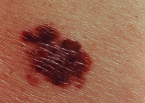 A color photograph of an irregularly colored mole