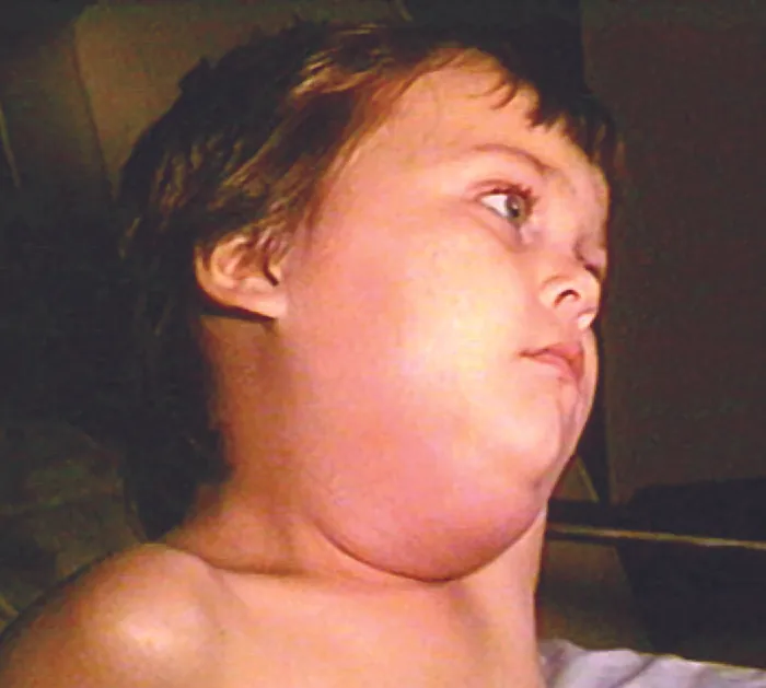A child with a very large swelling on one side of the neck.