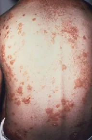 Photo of Erythrodermic psoriasis on back.