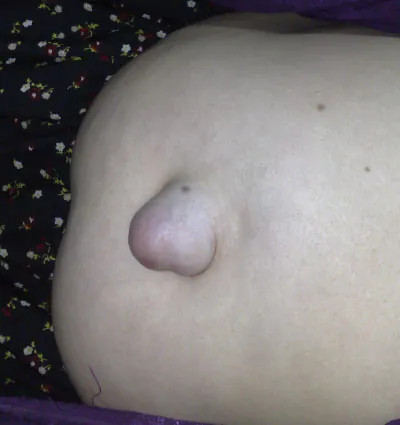 Umbilical hernia, soft abdominal protrusion