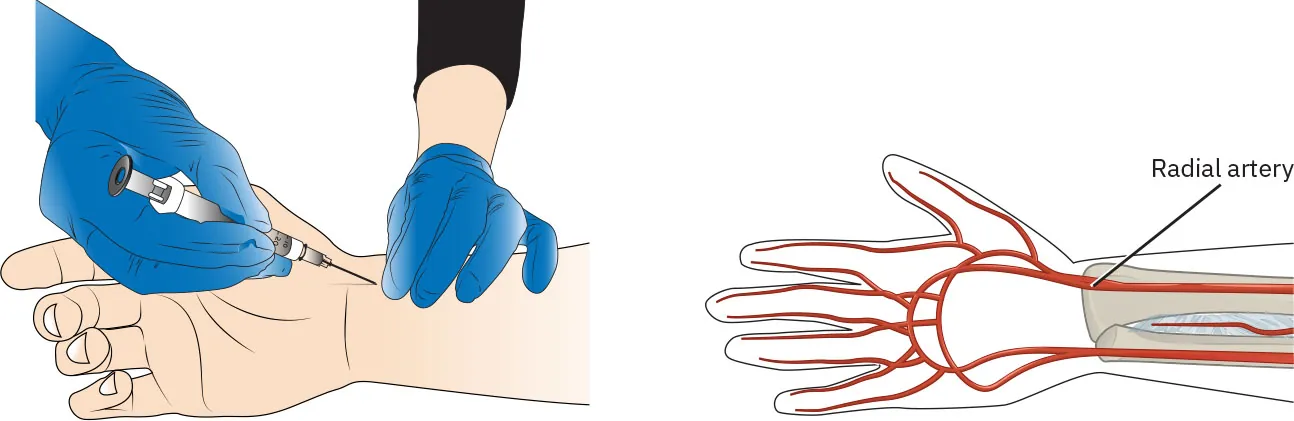 Two color illustrations showing the location of the radial artery on one side and the use of a needle to enter the radial artery on the other.