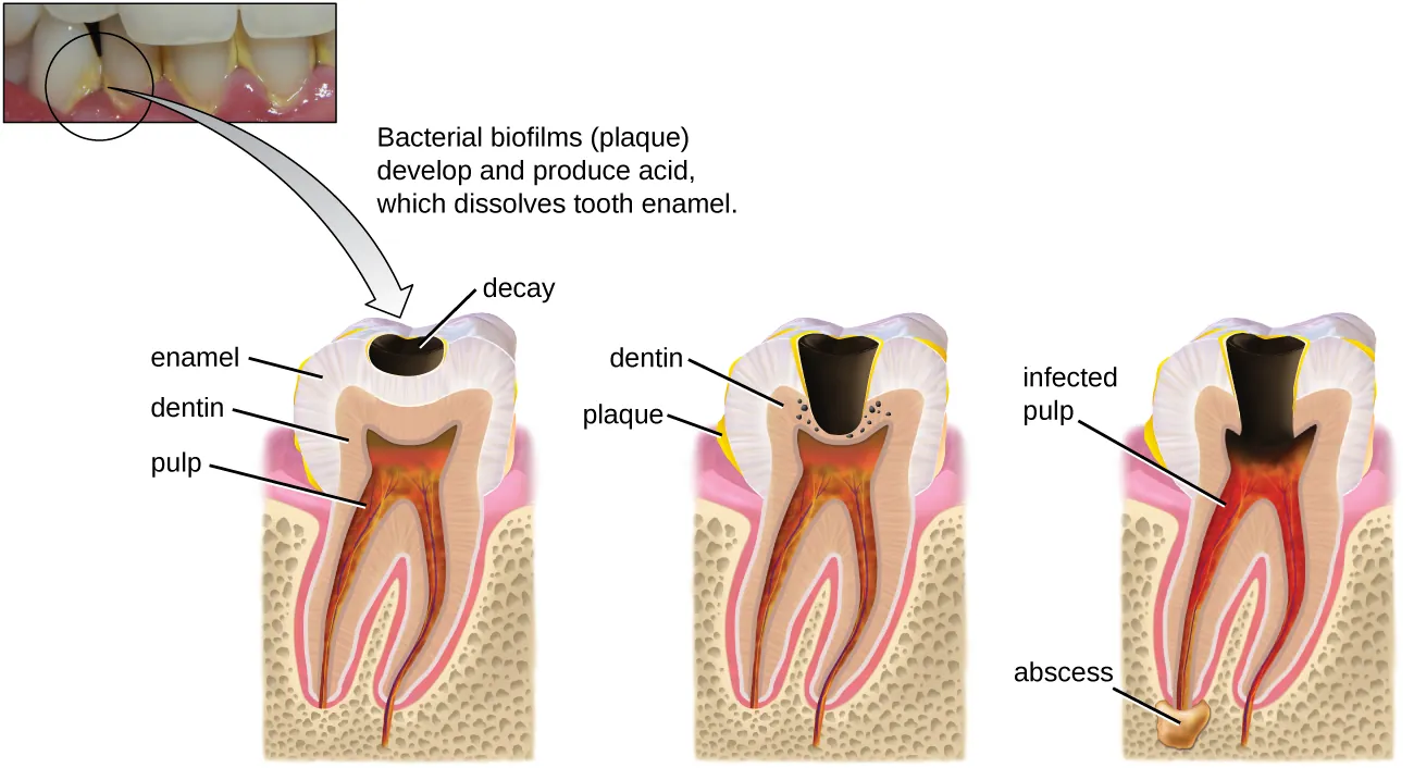 Teeth with yellow plaque. Description below.