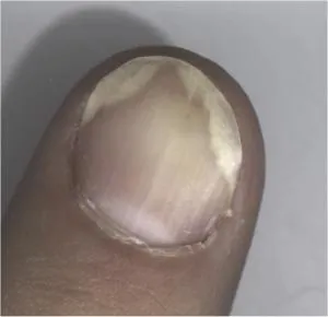 Psoriasis affecting a fingernail.