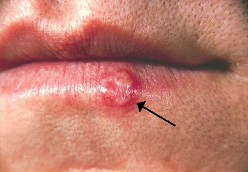 Cold sore on a lip.