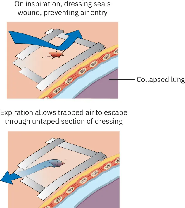 Diagram showing temporary dressing for collapsed lung: On inspiration, dressing seals wound, preventing air entry; Expiration allows trapped air to escape through untaped section of dressing.
