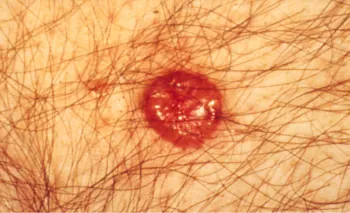 A color photograph showing a red mole