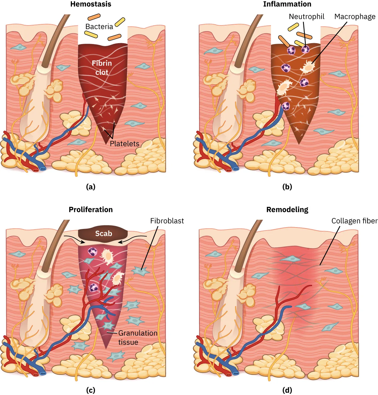 A four-panel diagram showing the stages of healing. The stages include hemostasis (showing the bacteria and fibrin clot), inflammation (showing the neutrophil and macrophage), proliferation (showing the scab, fibroblast, and granulation tissue), and remodeling (showing the collagen fiber).