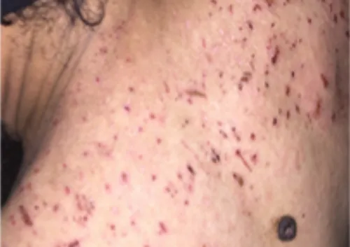 A color photograph showing a person’s back with pediculosis corporis