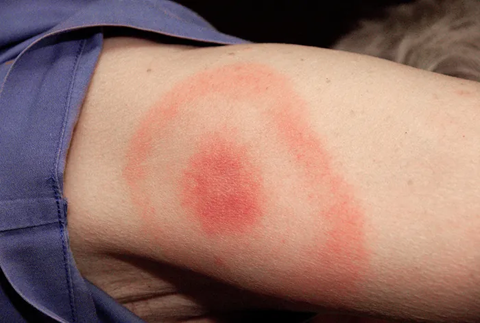Bulls-eye rash. Description in caption.