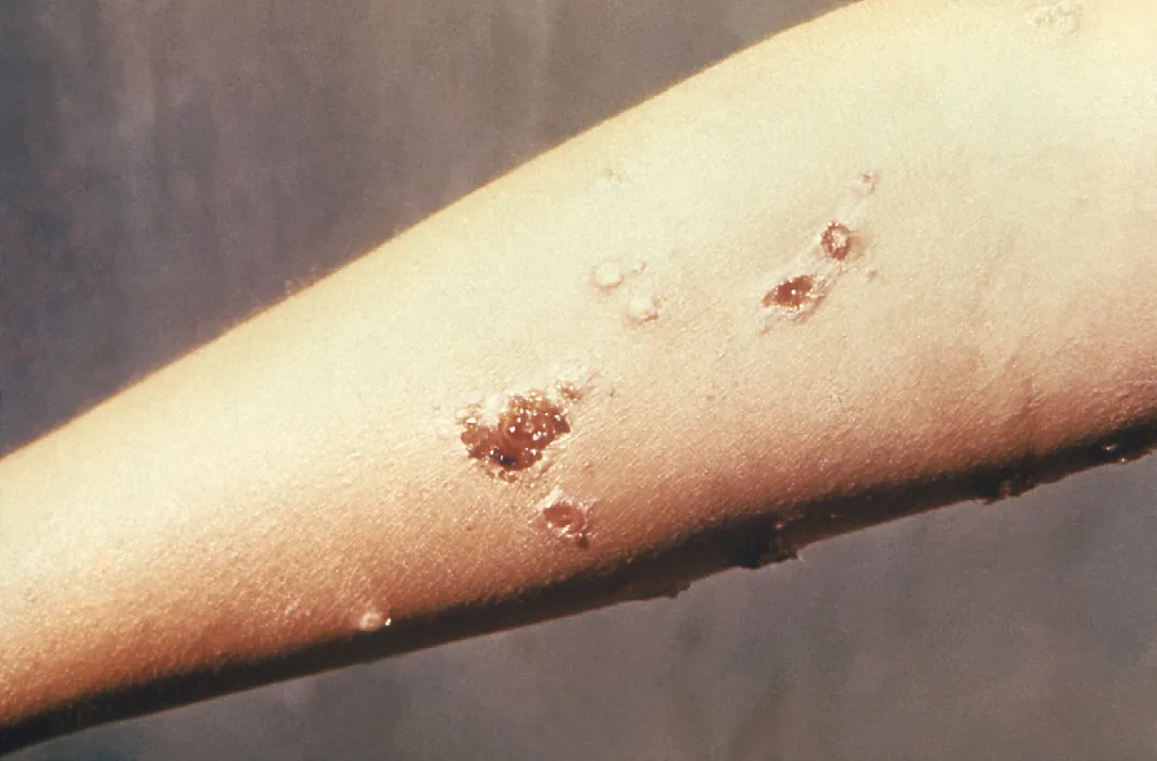 A closeup photo of an arm with impetigo shows small, round pustules, as well as some that have erupted and scabbed over.
