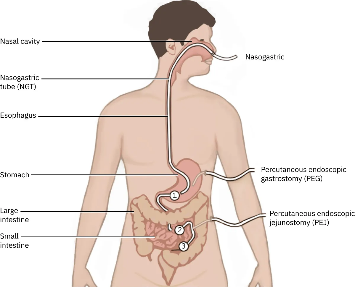 Diagram showing different access points for enteral tubes: nasogastric tube (NGT) inserted through nasal cavity, through esophagus, stomach, and small intestine; percutaneous endoscopic gastronomy (PEG) inserted into stomach; Percutaneous endoscopic jejunostomy (PEJ) inserted into small intestine