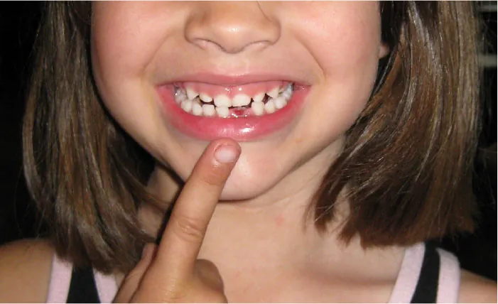Photo of young child pointing to a missing tooth in their mouth.
