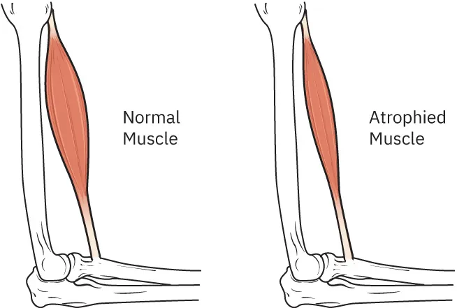 A pair of color simple illustrations showing a normal leg muscle and an atrophied muscle. The atrophied muscle is much smaller.