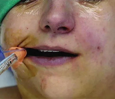 A photo of a patient with cyanosis of the lips.