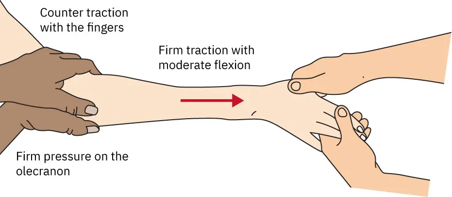 Diagram showing closed reduction of fracture of the lower arm, labeling Counter traction with the fingers, Firm pressure on the olecranon, and Firm traction with moderate flexion