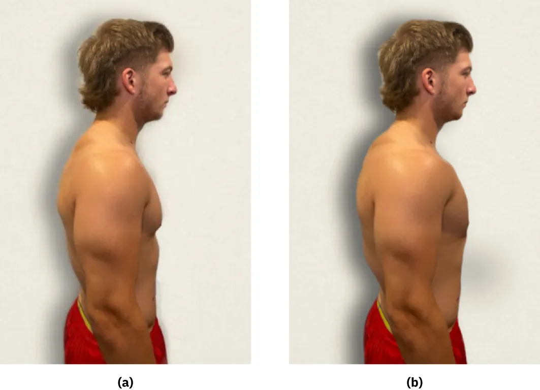 Photographs showing comparison of chest with normal anterior/posterior diameter to barrel chest.