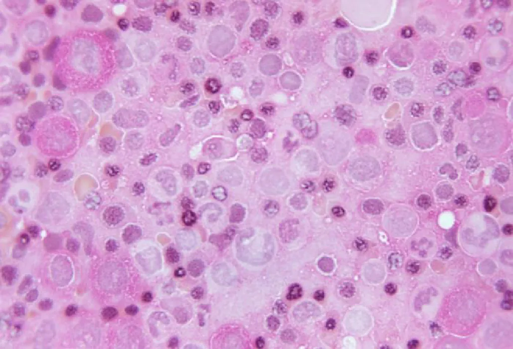 Anemic blood under the microscope. Most of the smaller red blood cells are pale, although there are a few that are darker. These red blood cells surround the larger white blood cells.