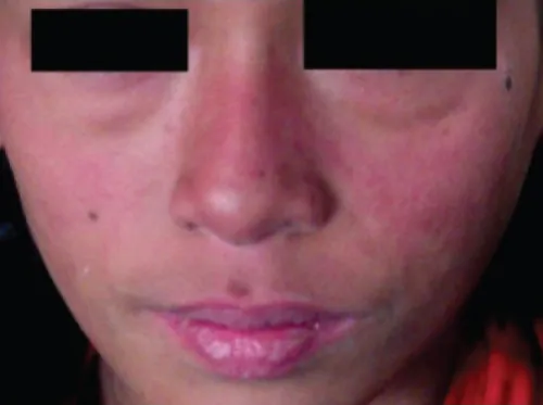 A color photograph shows a woman’s face with butterfly rash.