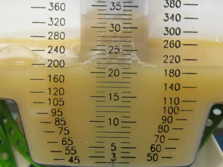 A photograph of urine from a urinary tract infection. The urine is milky yellow.