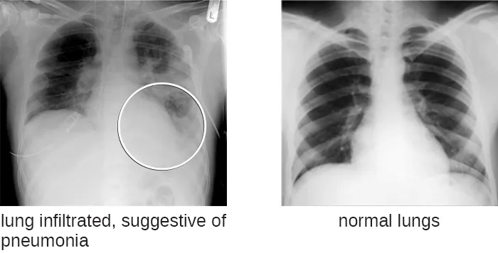 Chest X-rays. Description below.