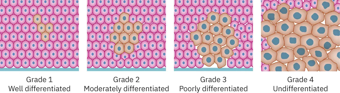 Diagram showing cells under microscope with grade labels: Grade 1 Well differentiated, Grade 2 Moderately differentiated, Grade 3 Poorly differentiated, Grade 4 Undifferentiated
