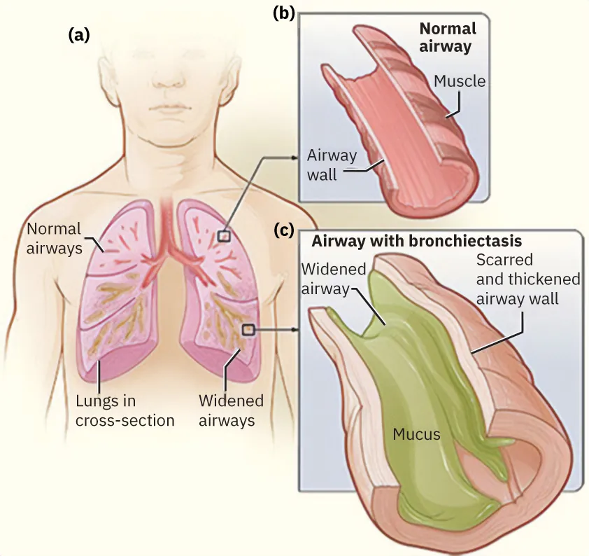 Diagram showing (a) normal airways, lungs in cross-section, widened airways; (b) normal airway, muscle, airway wall; (c) airway with bronchiectasis, widened airway, scarred and thickened airway wall, mucus.
