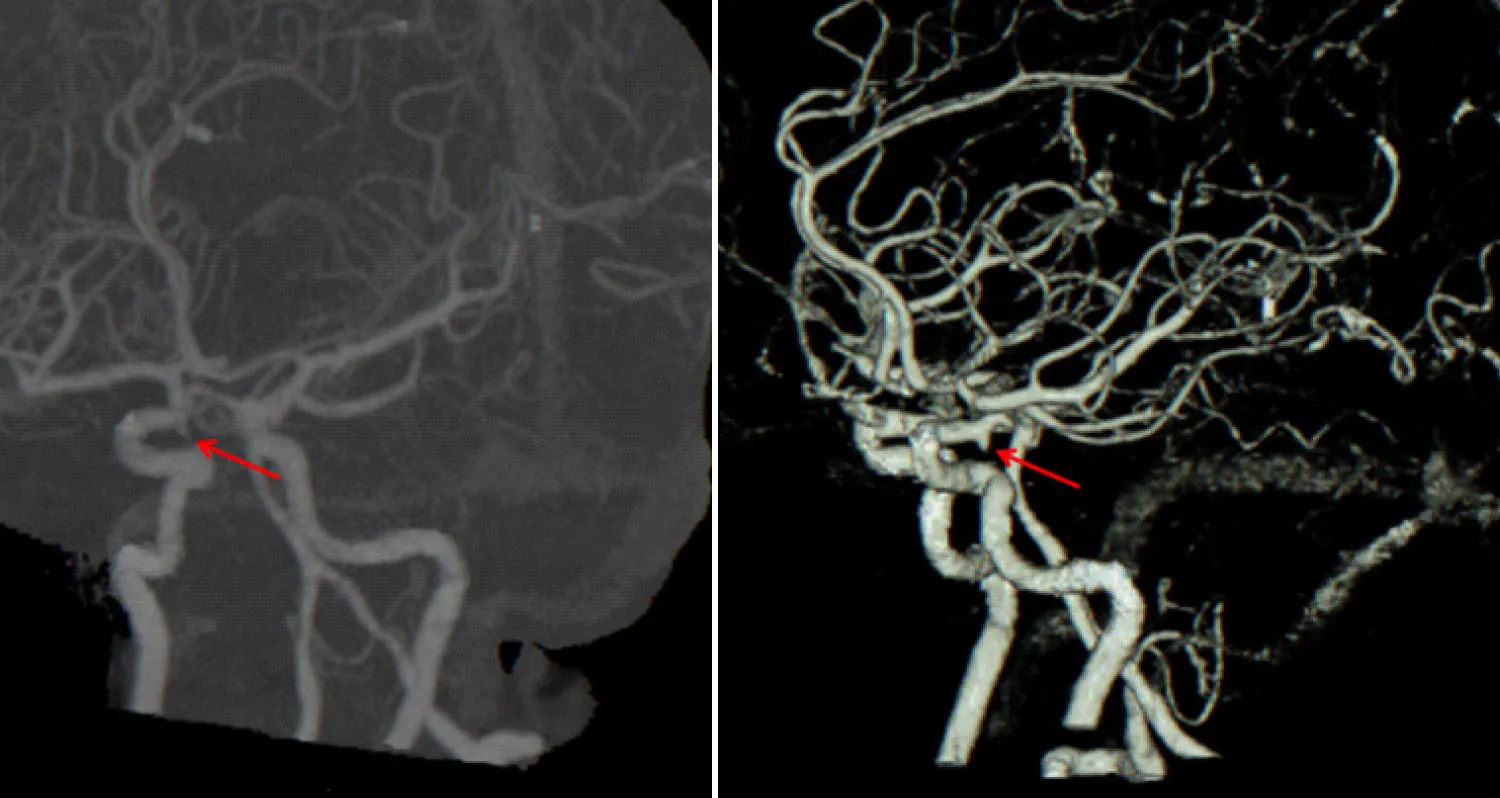 Computed tomography angiography showing an aneurysm.