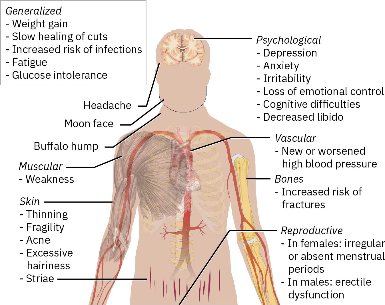 A diagram of Cushing syndrome symptoms.