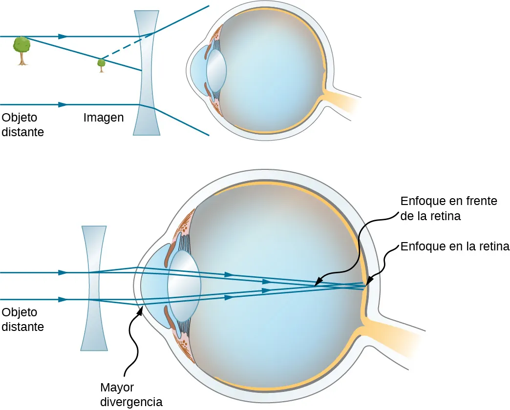 La figura muestra dos ojos con una lente bicóncava delante de cada uno. La primera muestra un árbol como objeto lejano, y la imagen del árbol más cerca de la lente. La segunda muestra los rayos paralelos procedentes del objeto lejano que inciden en el cristalino y divergen antes de incidir en la córnea. Luego convergen en la retina.
