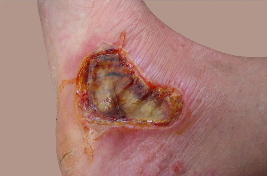 Photo of a third degree burn on a foot.