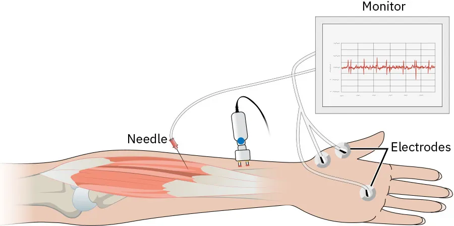 The image is an illustration of an electromyography (EMG) setup on a human arm. The illustration shows a needle inserted into the muscle of the forearm to measure electrical activity. Electrodes are placed on the skin surface of the arm and hand. Wires from the needle and electrodes connect to a monitor that displays a graph of the muscle’s electrical activity. The diagram highlights the internal muscles of the forearm, the needle, the electrodes on the skin, and the monitor showing the recorded signals. This setup is used to assess the health of muscles and the nerve cells that control them.