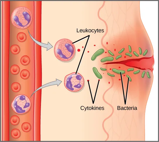 Illustration shows a capillary near the surface of skin that has a cut in it. Bacteria have penetrated the skin around the cut. In response, mast cells in the lower part of the skin tissue release histamines, and dendritic cells release cytokines. The histamines cause the capillary to become permeable. Neutrophils and monocytes exit the capillary into the damaged skin. Both the neutrophil and macrophage release cytokines and consume bacteria by phagocytosis.