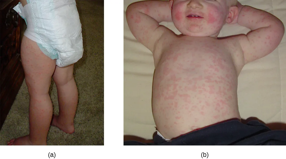 Red patches on an infant’s legs. Red spots on a child’s trunk.