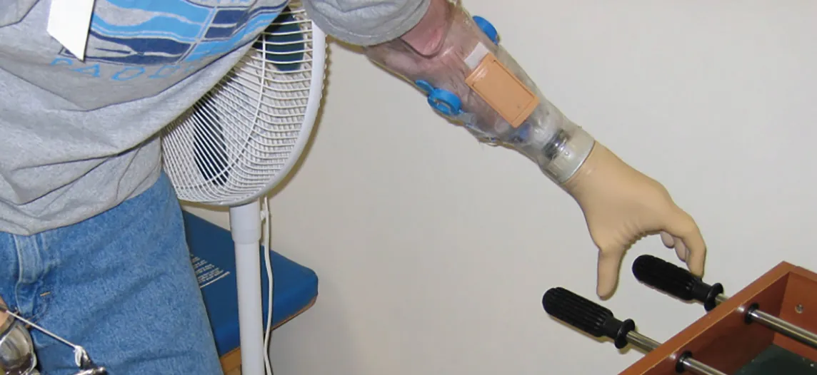 This photo shows a person playing foosball. The person has had both of their lower arms amputated. The left arm was replaced with a replica of a human hand and the right arm was replaced with a manipulator that resembles a pair of tongs.